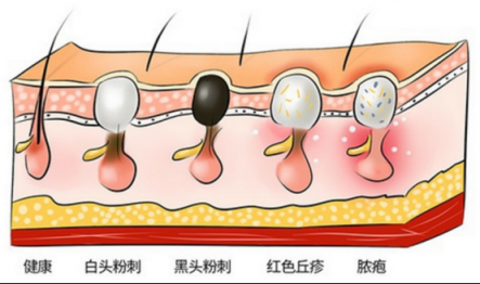 讓黑頭乖乖跑出來，黑頭儀有用嗎？