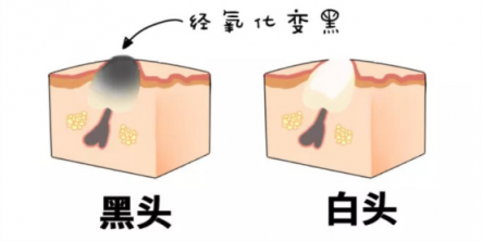 黑頭儀有用嗎？實力派去黑頭就選它！