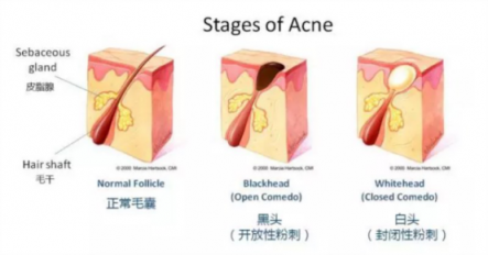 黑頭儀有用嗎？用了它終于擺脫了頑固黑頭！