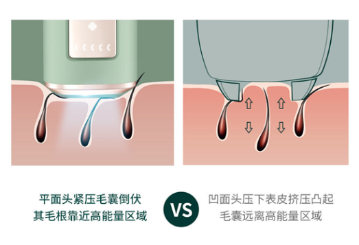 Ulike藍(lán)寶石脫毛儀：打開無痛脫毛新世界大門