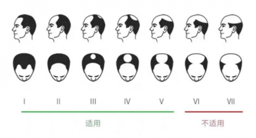 小米眾籌銷量驚人的可思美激光生發(fā)帽，真的能生發(fā)嗎？