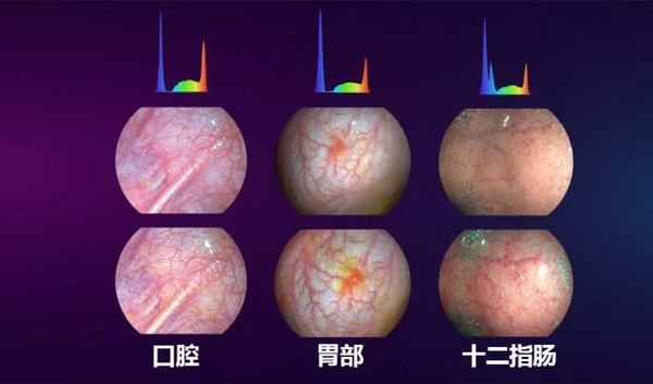 光隨影動(dòng) 開(kāi)立醫(yī)療國(guó)產(chǎn)內(nèi)鏡功能領(lǐng)跑智能新方向