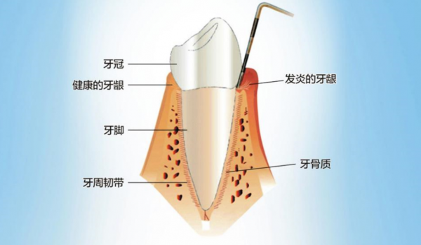 牙縫變大、總?cè)?，警惕“牙周病?/></p><p><strong>牙周病發(fā)病隱匿，早期一般無(wú)癥狀</strong></p><p>李永劍院長(zhǎng)介紹，牙周病是指發(fā)生在牙周組織的疾病，包括牙齦組織的牙齦病和波及深層牙周組織(牙周膜、牙槽骨、牙骨質(zhì))的牙周炎兩大類。牙周疾病是常見的口腔疾病，也是引起成年人牙齒喪失的首要原因。</p><p>“牙周病與齲齒不同，它起病隱匿，初期不會(huì)疼痛，早期僅有出血等輕微癥狀，且病程長(zhǎng)，可達(dá)數(shù)年之久，因此很容易被忽視。” 李永劍院長(zhǎng)表示，牙周病的早期癥狀是刷牙和咬硬物出血，如果在這個(gè)階段進(jìn)行積極治療，效果好，花費(fèi)少。如果等到出現(xiàn)疼痛、腫脹、牙齒松動(dòng)、脫落或咀嚼功能障礙時(shí)，已錯(cuò)過最佳治療時(shí)機(jī)，不僅治療難度加大，治療費(fèi)用增加，而且無(wú)法恢復(fù)到原來的健康水平。</p><p align=