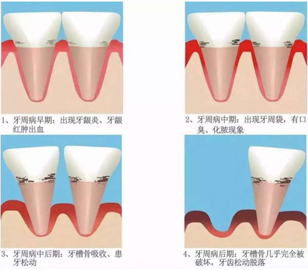 牙縫變大、總?cè)?，警惕“牙周病?/></p><p>同時(shí)，牙周炎會(huì)在不知不覺中使牙周組織遭到嚴(yán)重破壞，以致嚴(yán)重松動(dòng)牙齒不得不被拔除。就好比一棵大樹，牙根就像樹根，而牙齒周圍的組織，如牙齦、牙周膜、牙槽骨等就像樹根周圍的泥土。如果樹根周圍的泥土沒了，那么即使大樹沒有被蟲蛀，也會(huì)倒掉。同理，如果牙根周圍的牙齦發(fā)炎、牙槽骨破壞到一定程度，即使牙齒沒有爛也沒辦法保留。</p><p>據(jù)了解，根據(jù)第 4 次全國(guó)口腔健康流行病學(xué)的調(diào)查，國(guó)人牙齒出血率為 87.4%，牙結(jié)石檢出率 96.7%，嚴(yán)重牙周炎的檢出率為 52.7%。也就是說，平均 10 個(gè)人中 9 個(gè)有牙周病，5 個(gè)有比較重的牙周炎。</p><p><strong>那么，牙周病是如何形成的?</strong></p><p>李永劍院長(zhǎng)介紹，牙周炎的主要致病因子是牙菌斑，細(xì)菌及其產(chǎn)生的大量毒素刺激牙齦發(fā)炎，如果在這個(gè)階段進(jìn)行積極治療可以完全恢復(fù)牙周健康。相反如果牙齦炎癥繼續(xù)發(fā)展，導(dǎo)致牙周袋形成和牙槽骨吸收，最終的結(jié)果就是牙齒松動(dòng)和脫落。牙菌斑無(wú)法通過漱口或者藥物去除，最好的辦法是機(jī)械清除，一是正確的刷牙，輔助使用牙線、牙縫刷;二是由專業(yè)的口腔醫(yī)生進(jìn)行專業(yè)維護(hù)，控制牙菌斑。</p><p align=