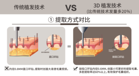 女性植發(fā)消費崛起，武漢新生植發(fā)3D植發(fā)高性價比受歡迎