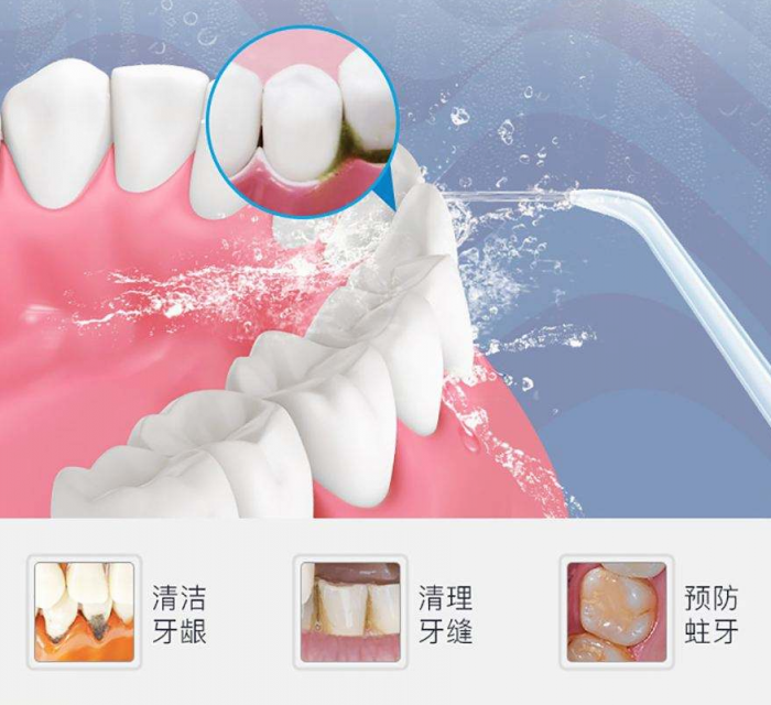 預防牙結石 XWAVES小蠻腰SE保衛(wèi)口腔健康