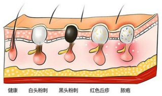 HomeFacialPro乳糖酸去黑頭鼻貼膜全新上市 抑制頑固黑頭反復上演